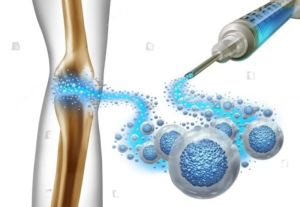 Role of Stem Cells in Treating Chronic Conditions